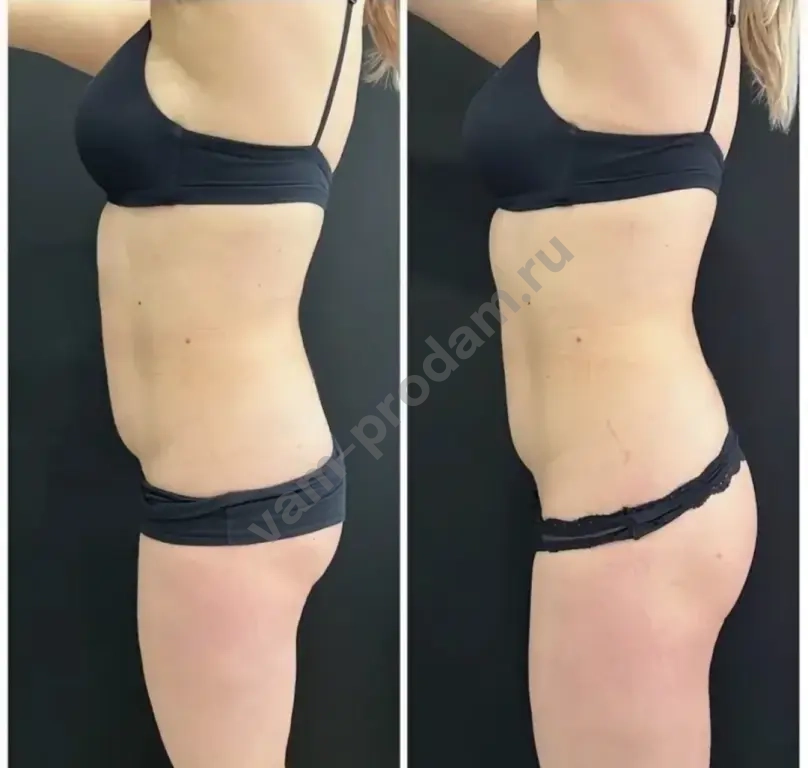 Модель на коррекцию фигуры