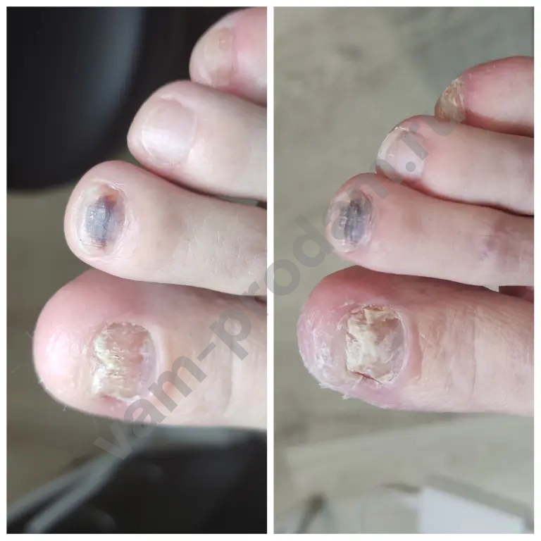 подологический педикюр