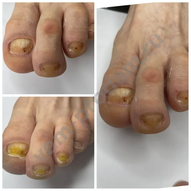 подологический педикюр