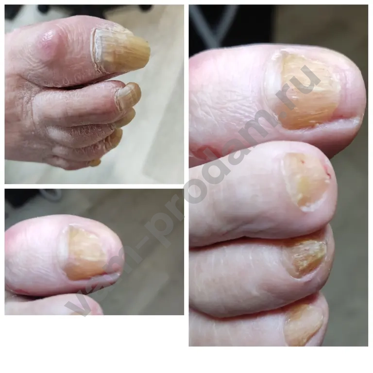 подологический педикюр