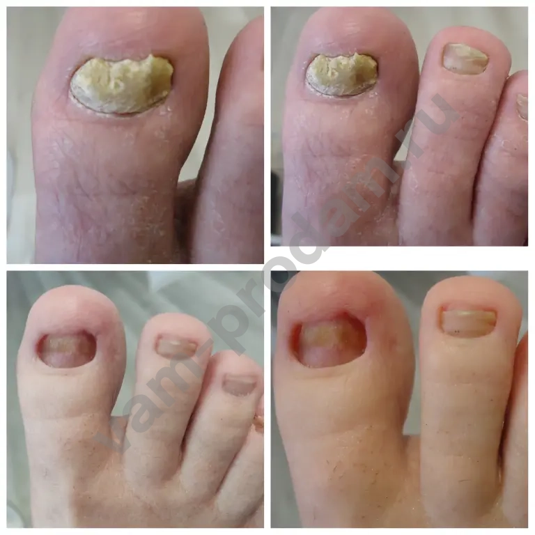 подологический педикюр