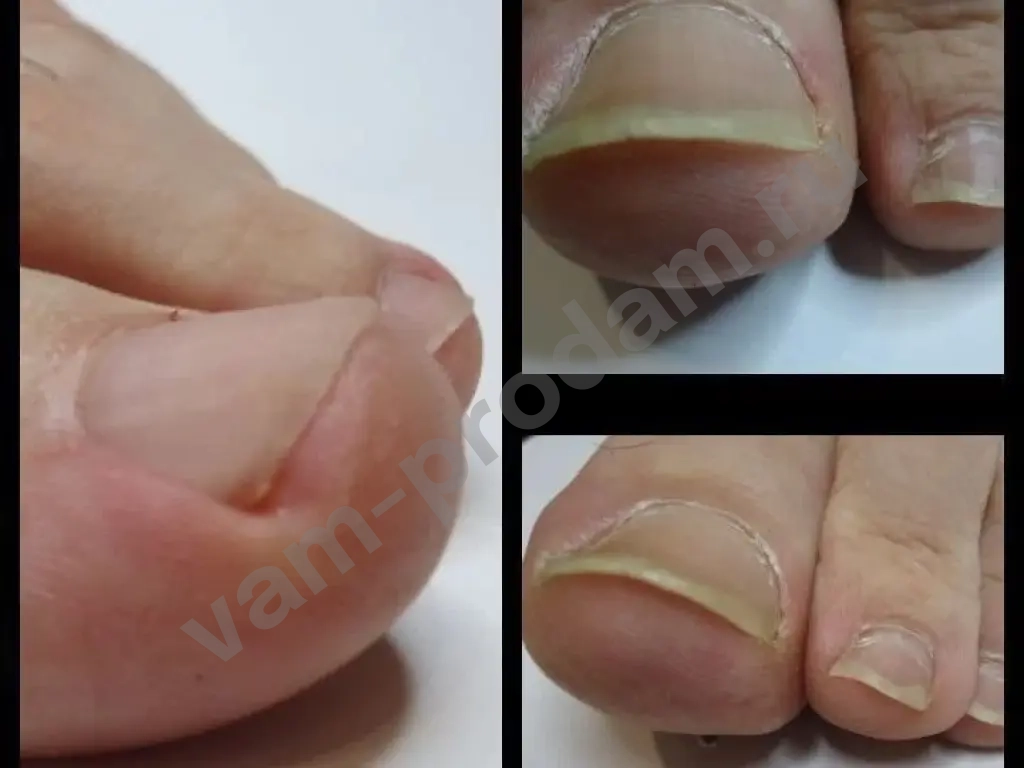 подологический педикюр