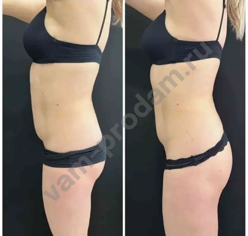 Требуется модель на коррекцию фигуры бесплатно