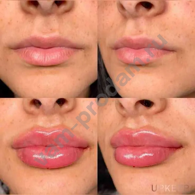 Увеличение губ