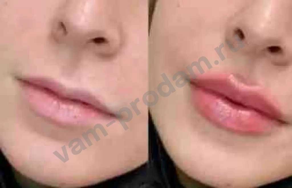 Увеличение губ