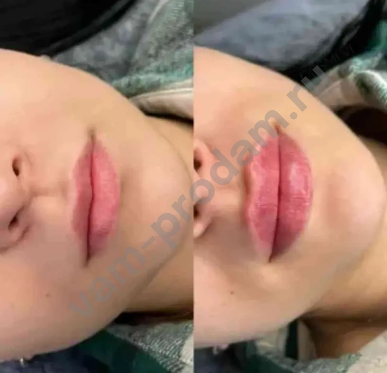 Увеличение губ