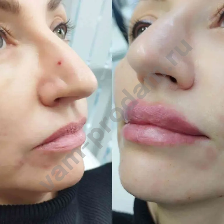 Увеличение губ