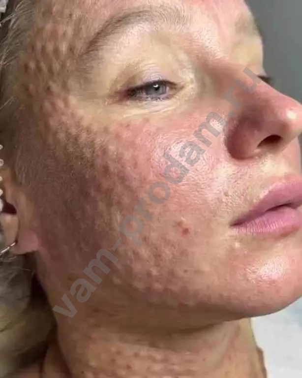 Биоревитализация