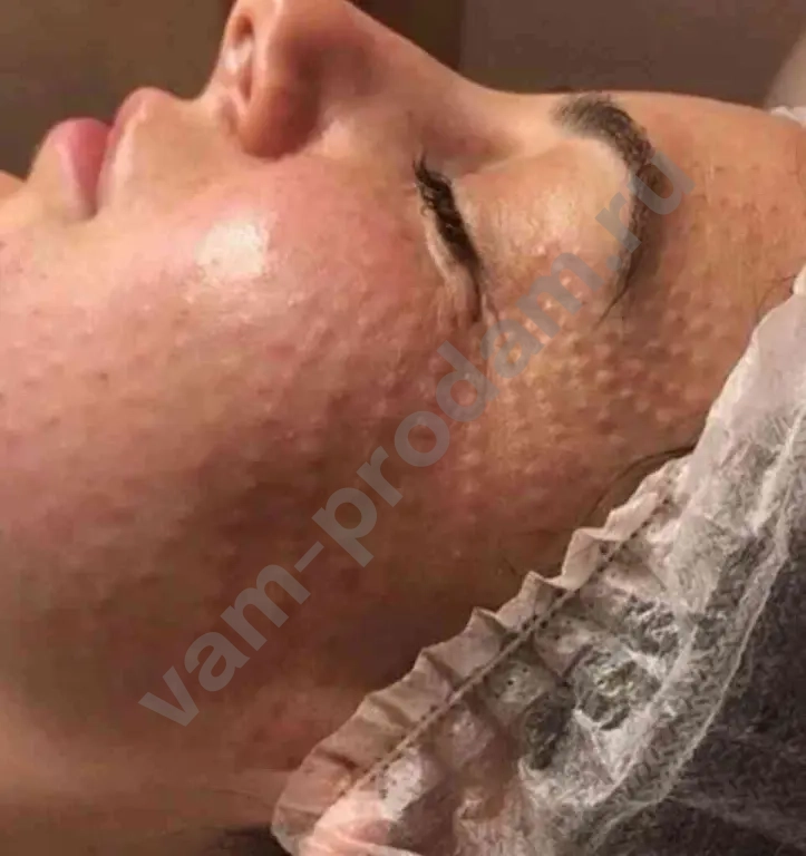 Биоревитализация