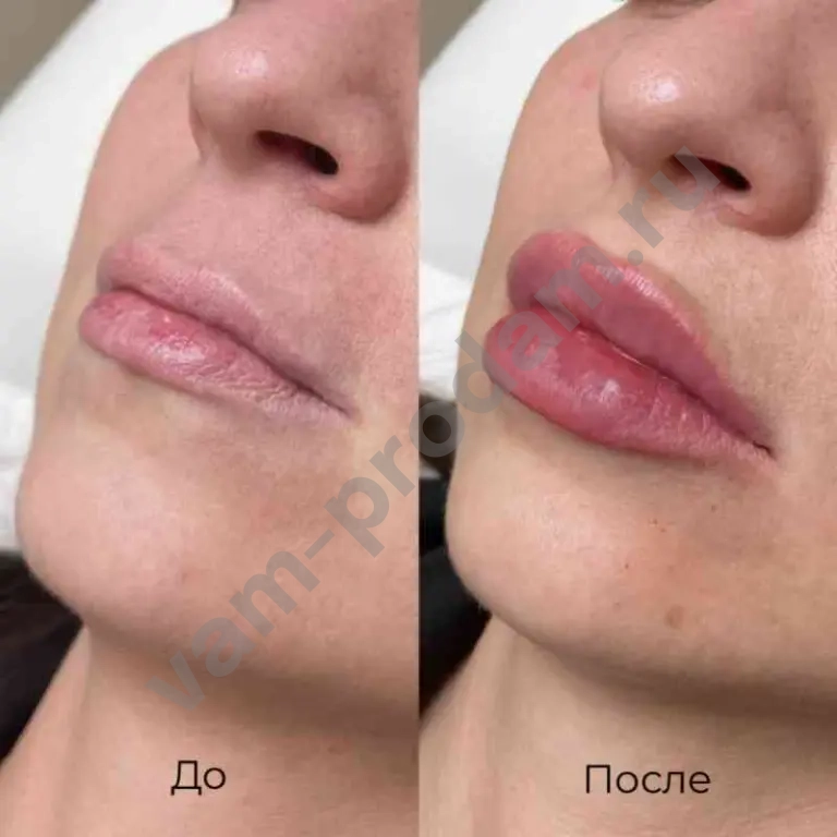 Увеличение губ